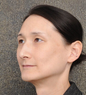 Facial Feminization Surgery (FFS)