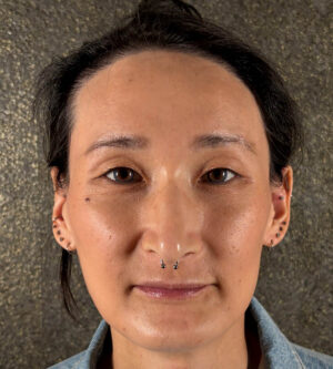 Facial Feminization Surgery (FFS)