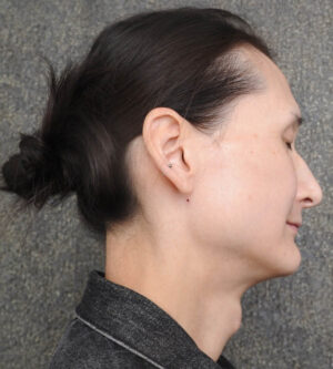 Facial Feminization Surgery (FFS)