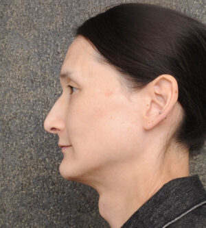 Facial Feminization Surgery (FFS)
