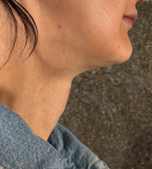 Facial Feminization Surgery (FFS)