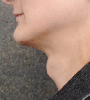 Facial Feminization Surgery (FFS)