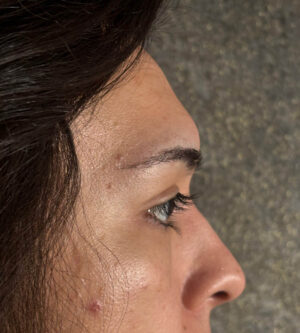 Brow Lift