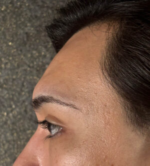 Brow Lift