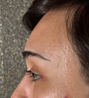 Brow Lift