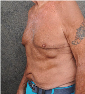 Tummy Tuck