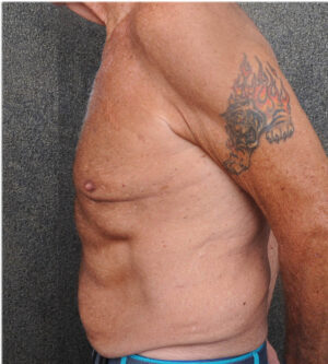 Tummy Tuck