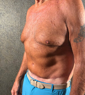 Tummy Tuck