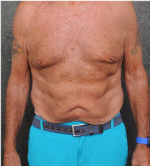 Tummy Tuck