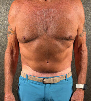 Tummy Tuck