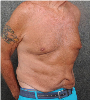 Tummy Tuck