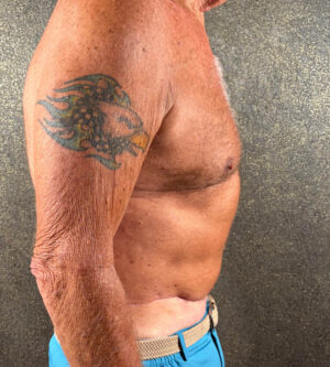 Tummy Tuck