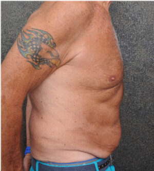 Tummy Tuck