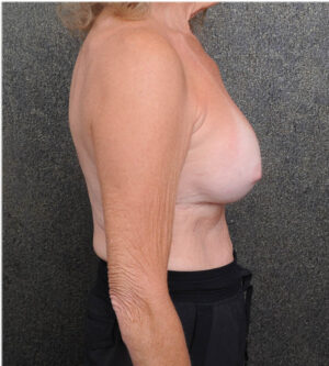 Breast Implant Exchange