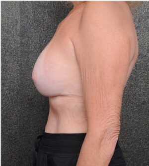 Breast Implant Exchange
