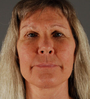 Facelift