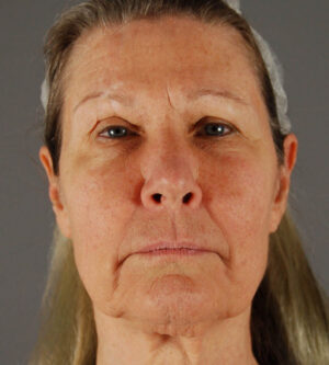 Facelift