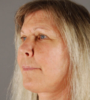 Facelift