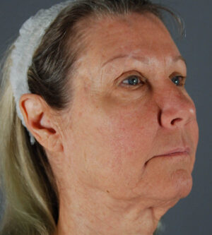 Facelift