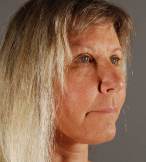 Facelift
