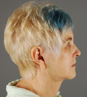 Facelift