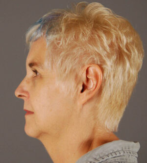 Facelift