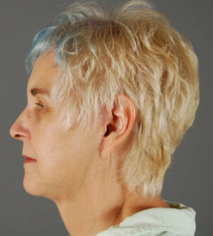 Facelift