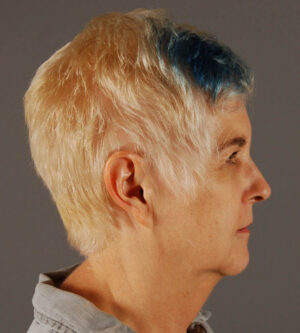 Facelift