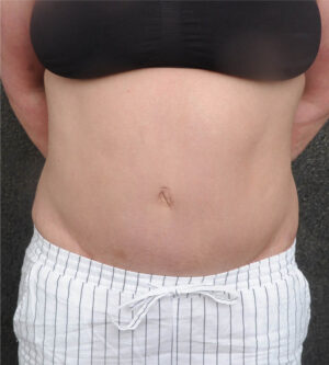 Liposuction