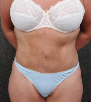 Liposuction