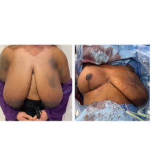 Breast Reduction