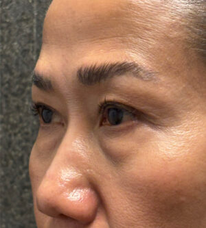 Eyelid Surgery