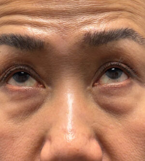 Eyelid Surgery