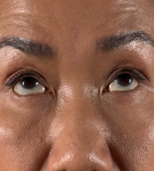 Eyelid Surgery