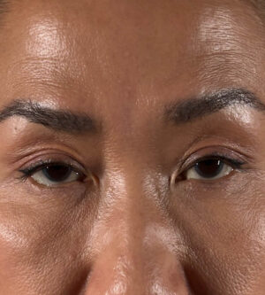 Eyelid Surgery