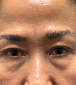Eyelid Surgery