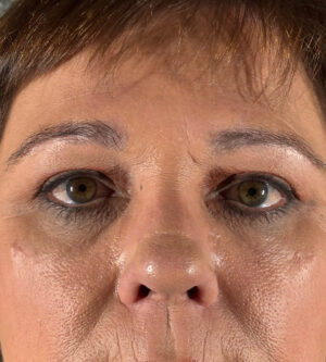 Festoon Removal