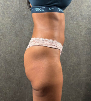 Butt Augmentation