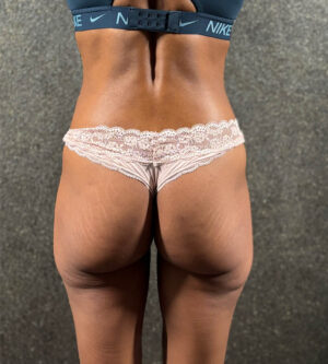 Butt Augmentation