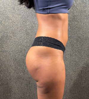 Butt Augmentation