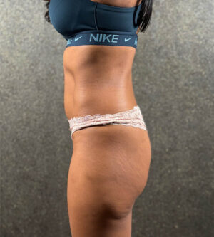 Butt Augmentation
