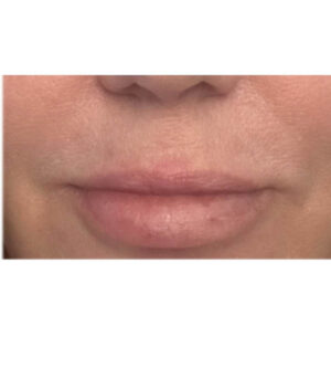 Lip Lift
