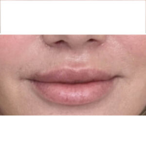 Lip Lift
