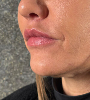 Lip Lift