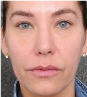 Lip Lift