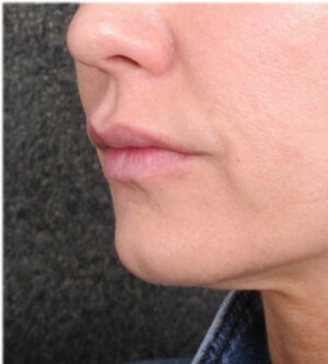 Lip Lift