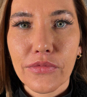 Lip Lift