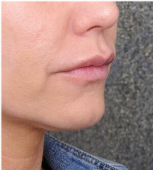 Lip Lift