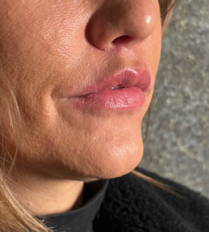 Lip Lift