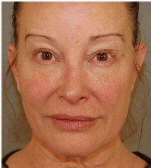 Eyelid Surgery